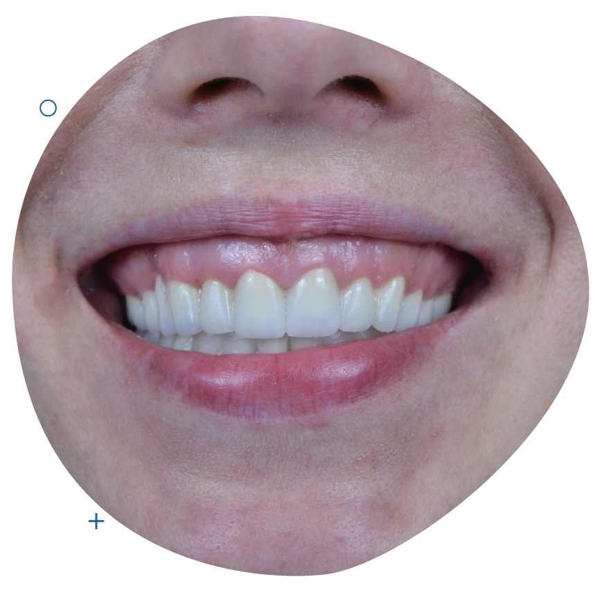<span class="bt_bb_before_after_image_after_text"> After</span>